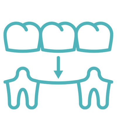 dental bridge