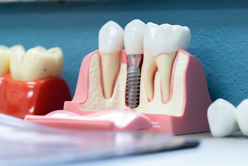 dental implant model