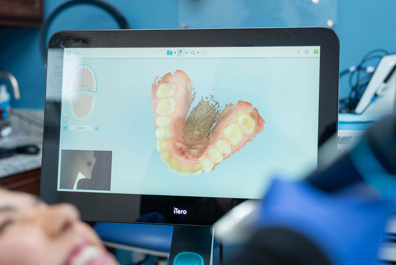 itero scanner digital scanning