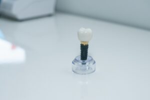 Dentist consulting patient about dental implant options
